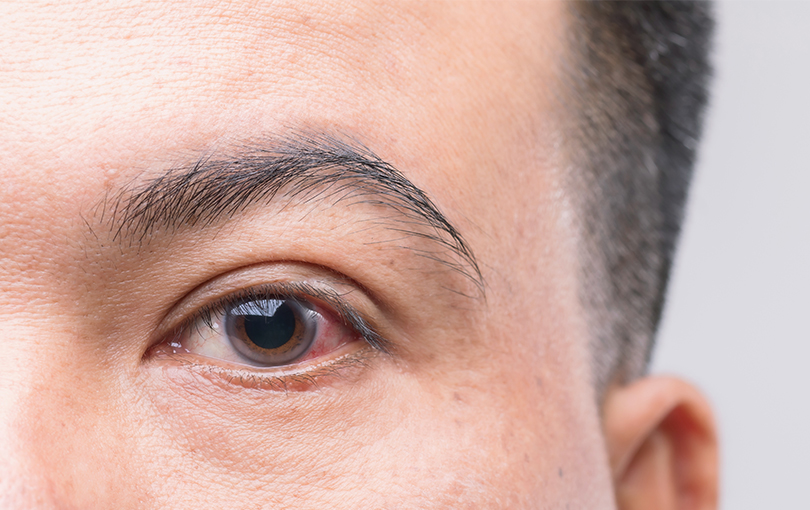 Oftalmologista em Balneário Camboriú – Fique atento aos sintomas do glaucoma
